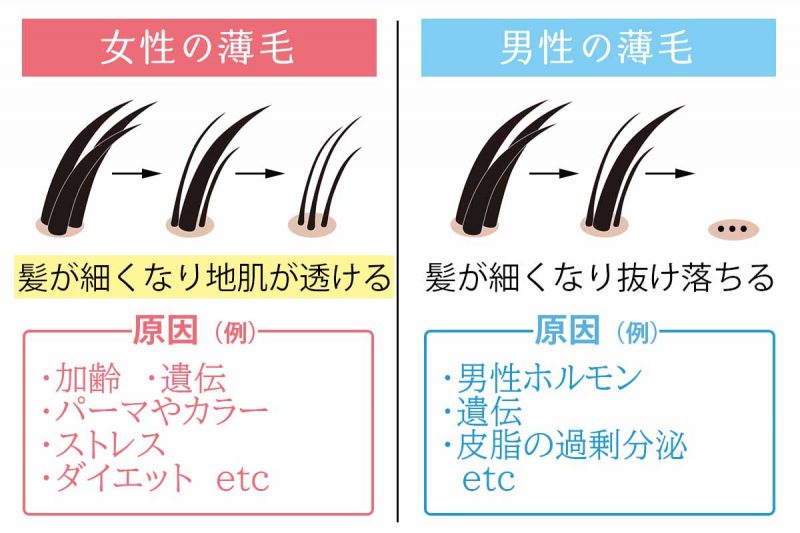 リリィジュ　男女の薄毛の違い